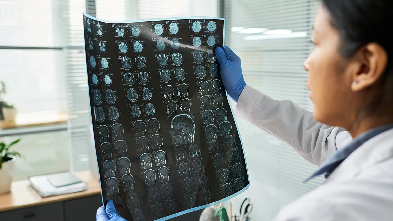 An AI model studies DNA to identify people who may have a higher risk of stroke.