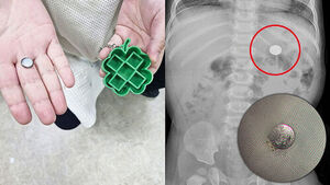 9-Month-Old Baby Swallows Lithium Battery, Saved by Emergency Helicopter Transport Across 230 km